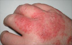 English: Photograph of typical, mild dermatitis