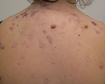 English: Cystic acne on the back.