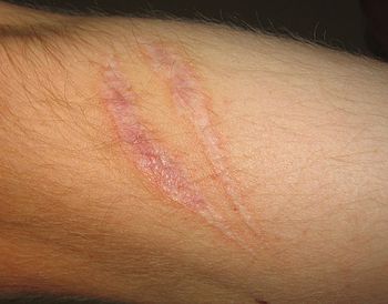 Scars present on the skin, evidence of fibrosi...