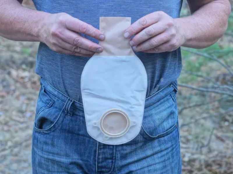 Stoma Inversion Life with a Stoma - Benefits of Privilege